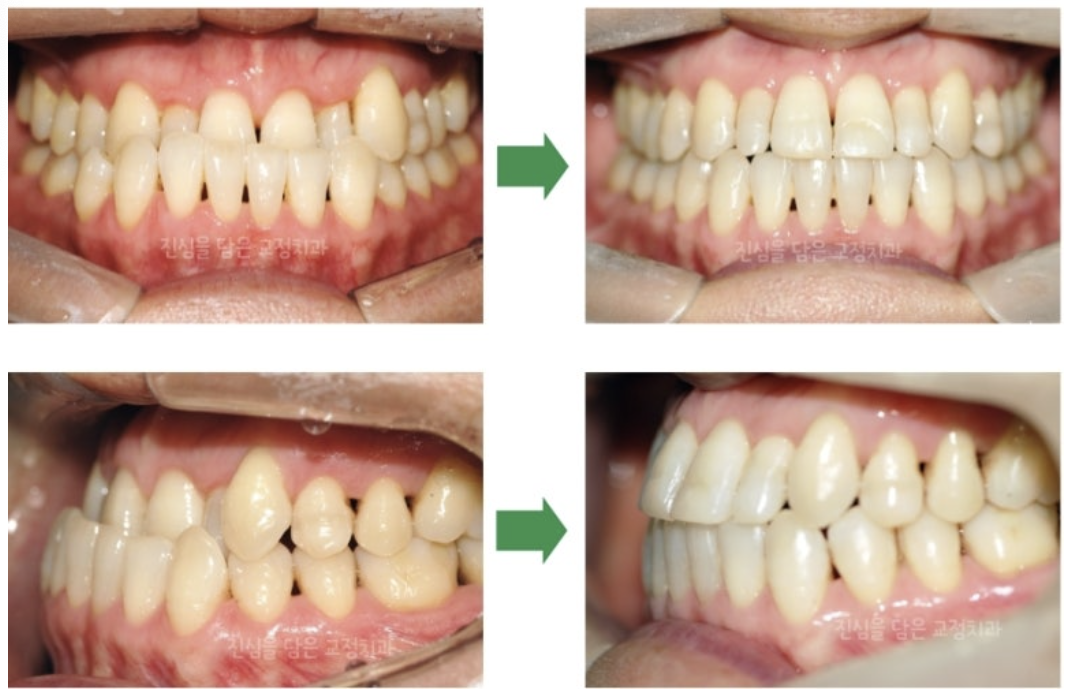 성인 주걱턱을 비수술로 교정한 사례
